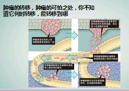 恶性肿瘤发生发展预防病例33页.ppt